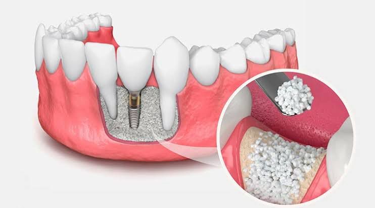 Revolution in Dental Implants: Stronger and More Durable Solutions with Bone Powder
